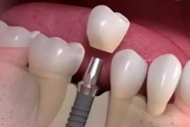 14 milhões de brasileiros vivem sem nenhum dente